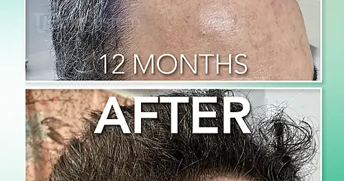 TJ Hair Clinic, transplante capilar en Tijuana, Baja California