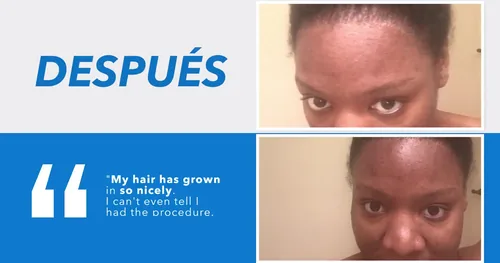 Neopel Hair Clinic, transplante capilar en Tijuana, Baja California