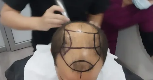HairMex Hair Transplant Clinic, transplante capilar en Tijuana, Baja California