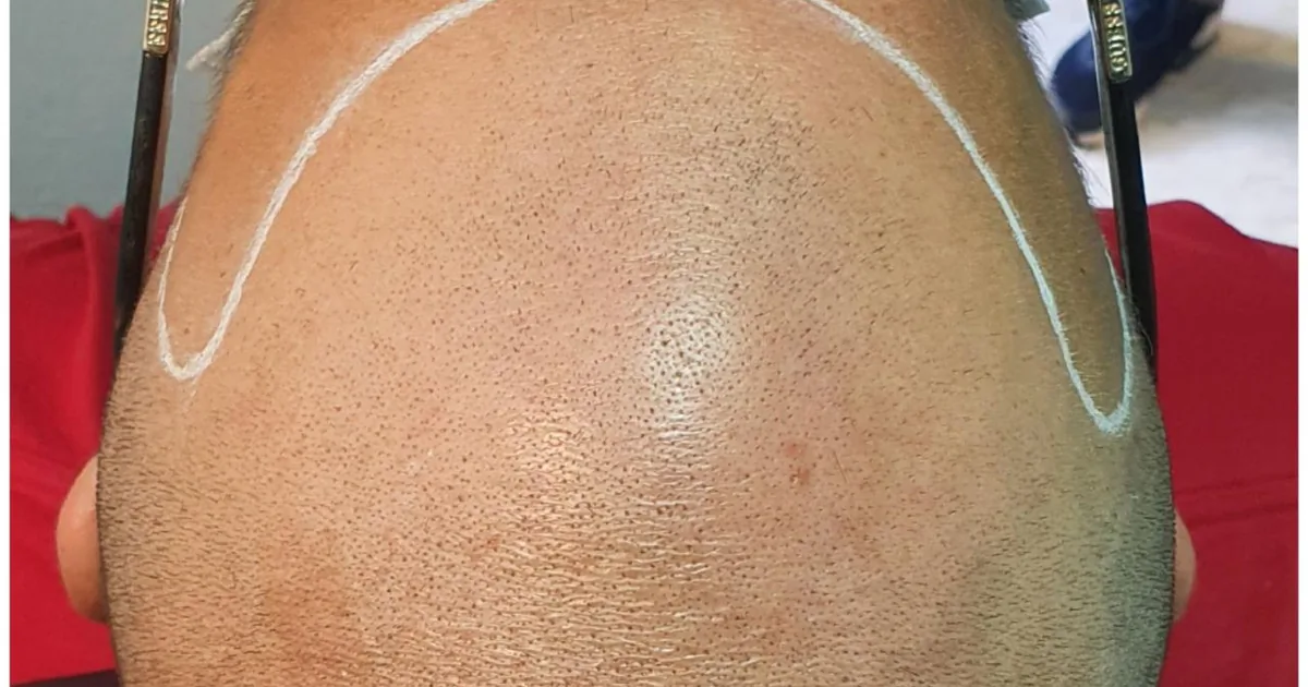 Smp Advanced – Scalp Micropigmentation Tijuana