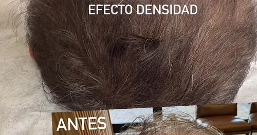Cabo Scalp Studio, transplante capilar en Los Cabos, Baja California Sur