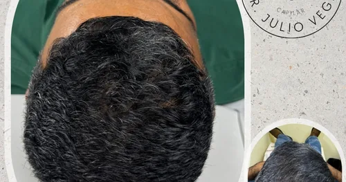 Injerto capilar Monclova, transplante capilar en Monclova, Coahuila
