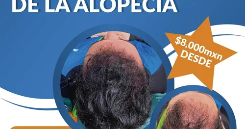MICROHAIR Micropigmentación Capilar, transplante capilar en Iztapalapa, Ciudad de México