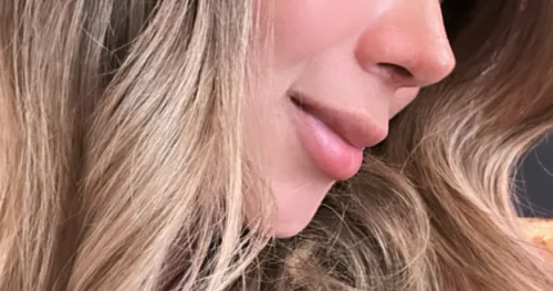 NASUS Rinoplastía y Cirugía Plástica Facial, transplante capilar en Tulancingo, Hidalgo