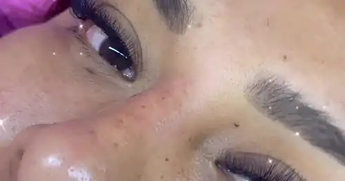 Estética Nuevas Formas, transplante capilar en Tuxtepec, Oaxaca